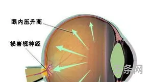 青光眼吧 这个视野正常吗(青光眼视野变化图)