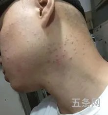 脸上长了好多密密麻麻的小疙瘩怎么去除